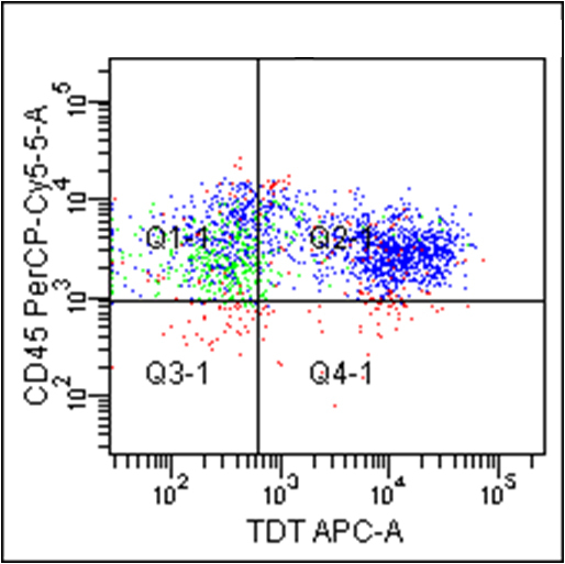 Lympho-blasts positive for Tdt, while myeloid blasts negative for Tdt.